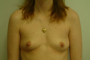 Breast Augmentation Before and After | Northside Plastic Surgery