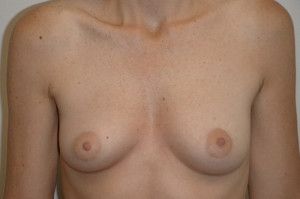 Breast Augmentation Before and After | Northside Plastic Surgery