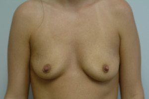 Breast Augmentation Before and After | Northside Plastic Surgery