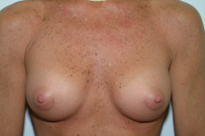 Breast Augmentation Before and After | Northside Plastic Surgery