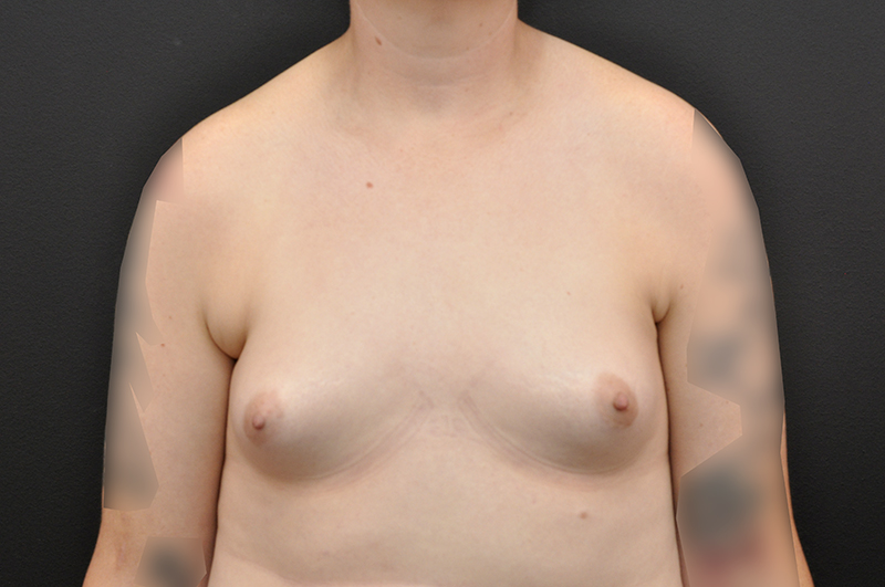 Breast Augmentation Before and After | Northside Plastic Surgery