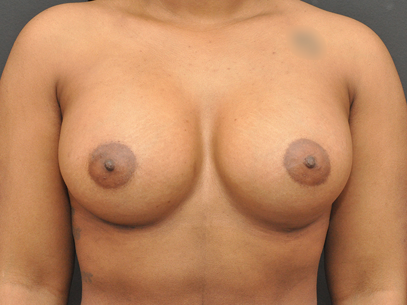 Breast Augmentation Before and After | Northside Plastic Surgery