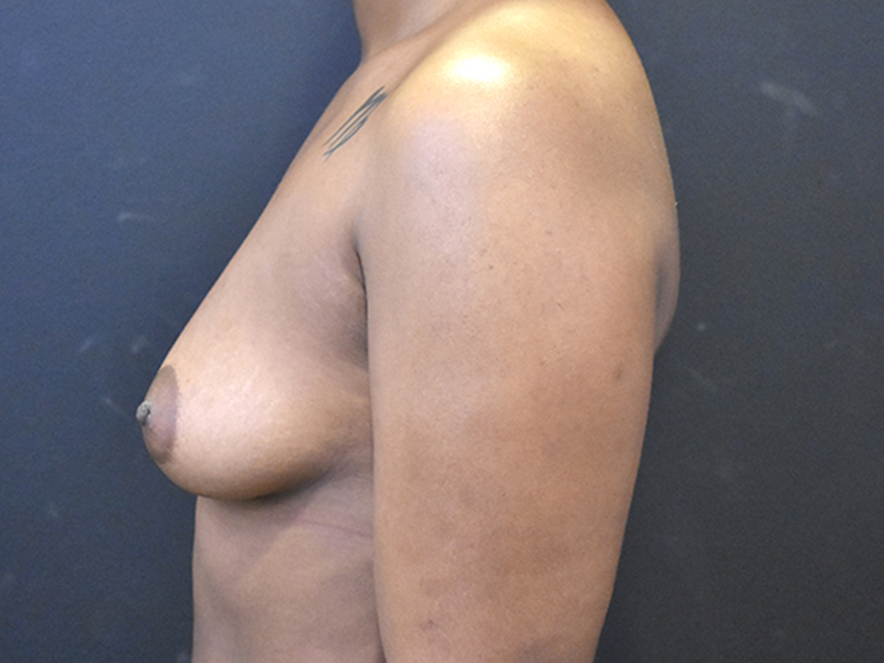 Breast Augmentation Before and After | Northside Plastic Surgery