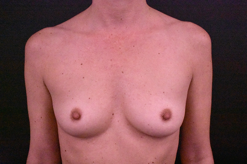 Breast Augmentation Before and After | Northside Plastic Surgery