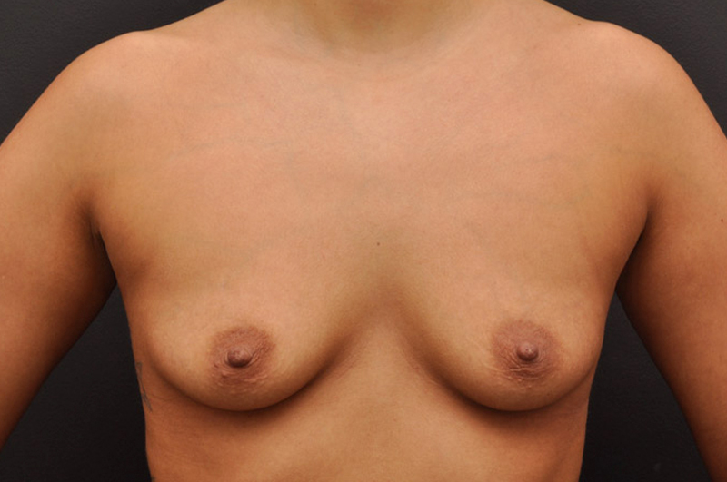 Breast Augmentation Before and After | Northside Plastic Surgery