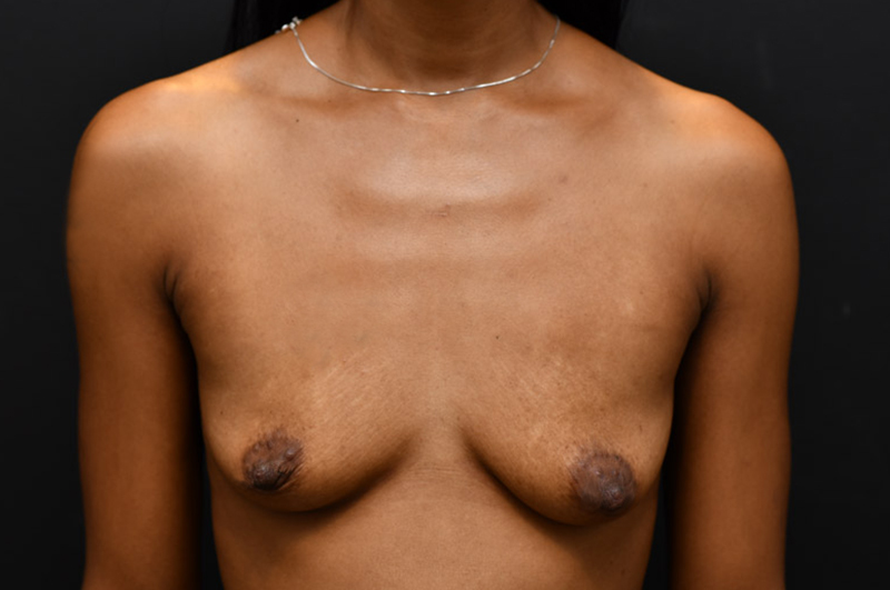 Breast Augmentation Before and After | Northside Plastic Surgery