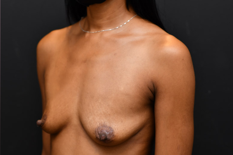 Breast Augmentation Before and After | Northside Plastic Surgery