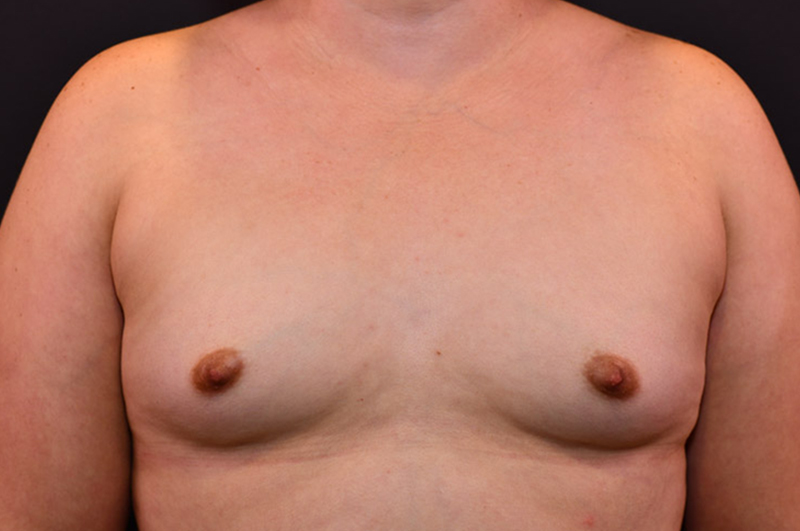 Breast Augmentation Before and After | Northside Plastic Surgery