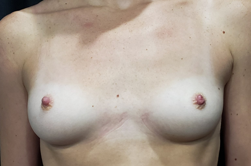 Breast Augmentation Before and After | Northside Plastic Surgery