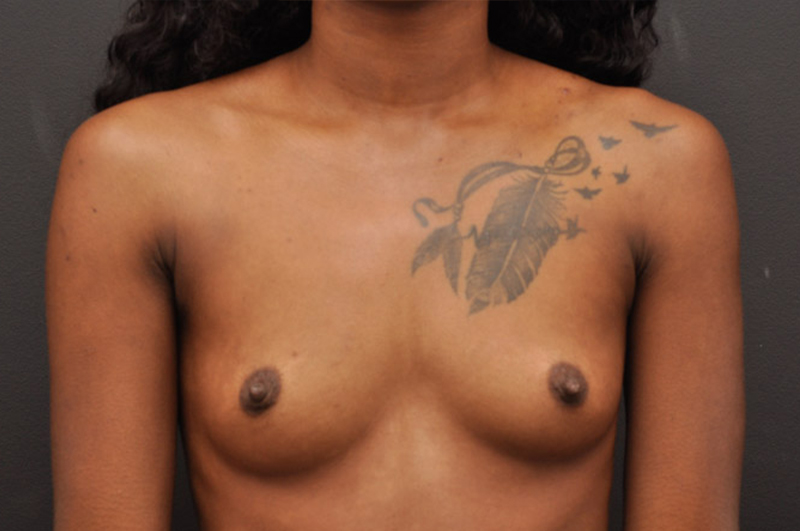 Breast Augmentation Before and After | Northside Plastic Surgery