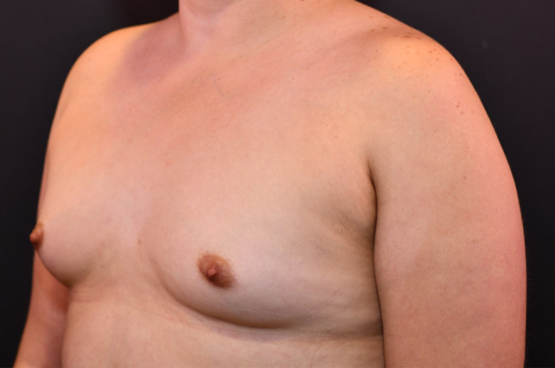 Breast Augmentation Before and After | Northside Plastic Surgery