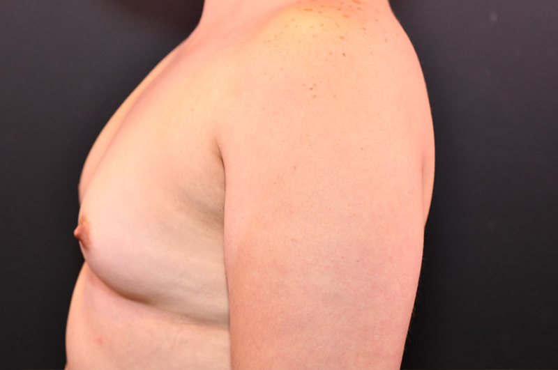 Breast Augmentation Before and After | Northside Plastic Surgery