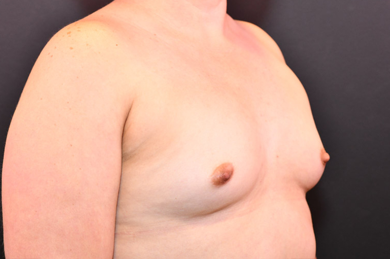 Breast Augmentation Before and After | Northside Plastic Surgery