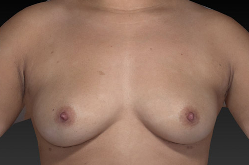 Breast Augmentation Before and After | Northside Plastic Surgery