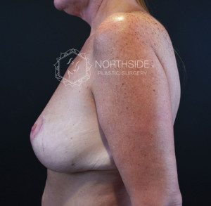 Breast Lift Before and After | Northside Plastic Surgery
