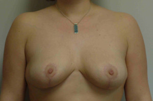 Breast Reduction Before and After | Northside Plastic Surgery