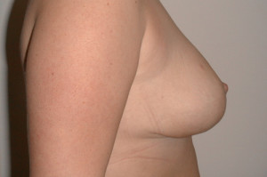 Breast Reduction Before and After | Northside Plastic Surgery