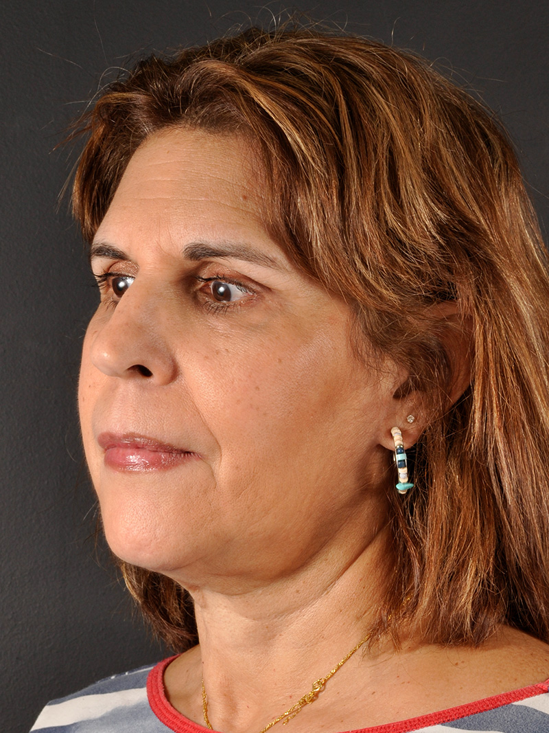 Buccal Fat Removal Before and After | Northside Plastic Surgery