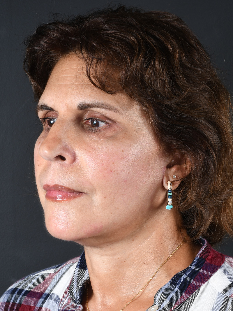 Buccal Fat Removal Before and After | Northside Plastic Surgery