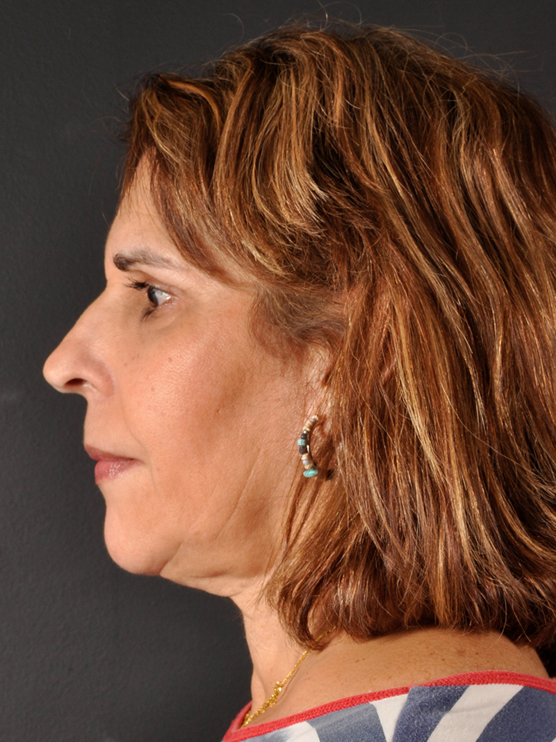 Buccal Fat Removal Before and After | Northside Plastic Surgery