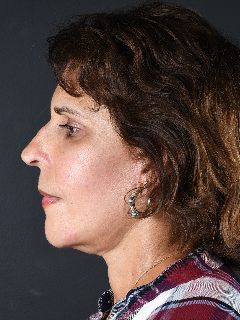 Buccal Fat Removal Before and After | Northside Plastic Surgery