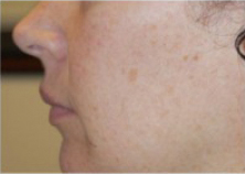 Chemical Peels Before and After | Northside Plastic Surgery
