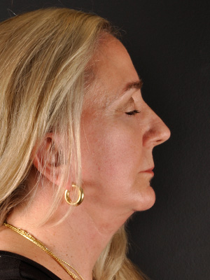 Chin Implant Before and After | Northside Plastic Surgery