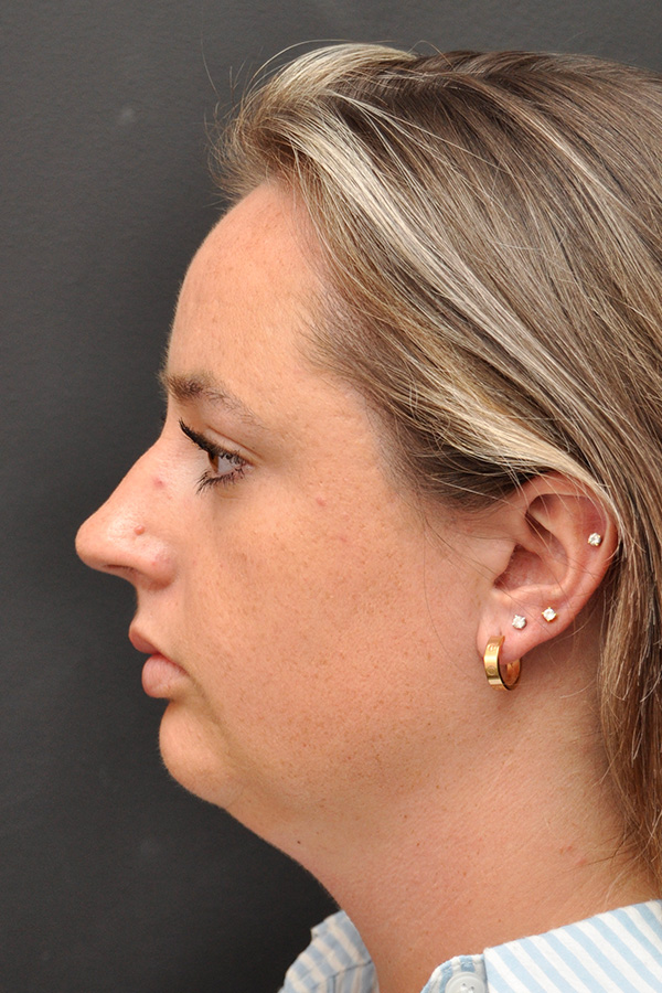 Chin Implant Before and After | Northside Plastic Surgery