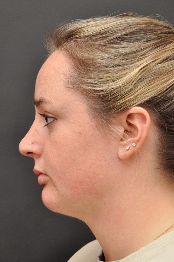 Chin Implant Before and After | Northside Plastic Surgery