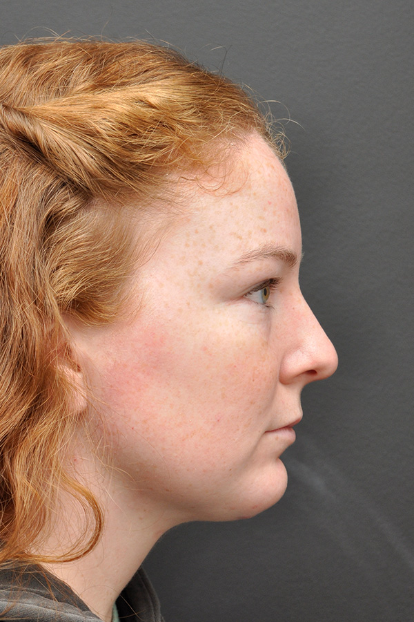 Chin Implant Before and After | Northside Plastic Surgery