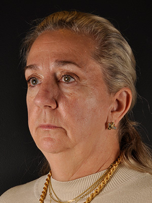 Chin Implant Before and After | Northside Plastic Surgery