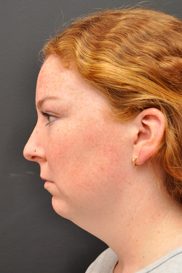 Chin Implant Before and After | Northside Plastic Surgery