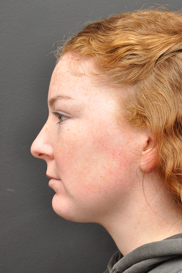 Chin Implant Before and After | Northside Plastic Surgery