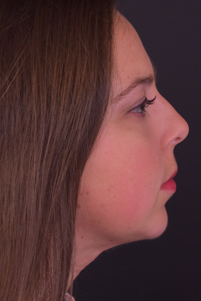 Chin Implant Before and After | Northside Plastic Surgery