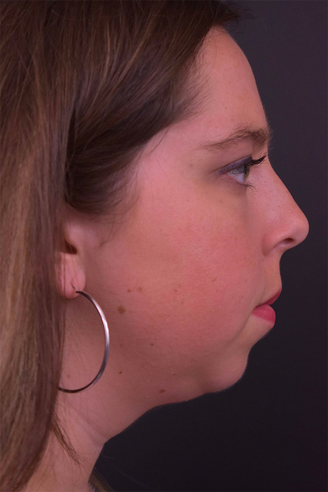 Chin Implant Before and After | Northside Plastic Surgery