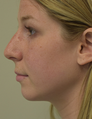 Chin Implant Before and After | Northside Plastic Surgery