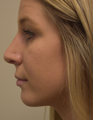 Chin Implant Before and After | Northside Plastic Surgery