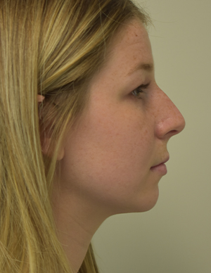 Chin Implant Before and After | Northside Plastic Surgery