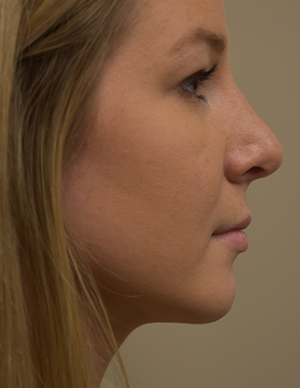 Chin Implant Before and After | Northside Plastic Surgery