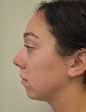 Chin Implant Before and After | Northside Plastic Surgery