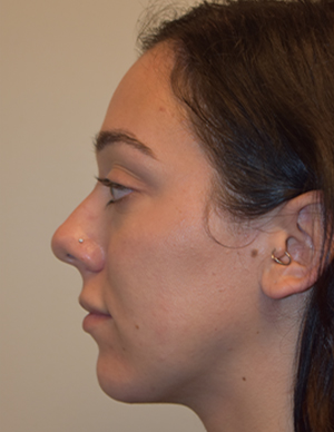 Chin Implant Before and After | Northside Plastic Surgery