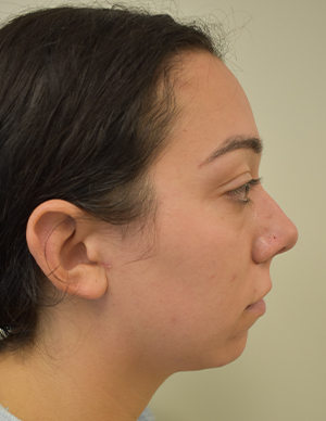 Chin Implant Before and After | Northside Plastic Surgery