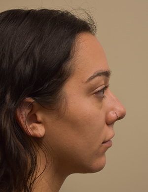 Chin Implant Before and After | Northside Plastic Surgery