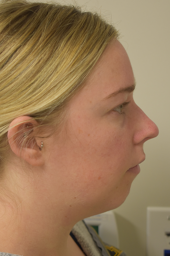 Chin Implant Before and After | Northside Plastic Surgery