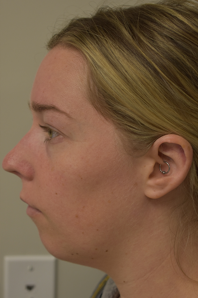 Chin Implant Before and After | Northside Plastic Surgery