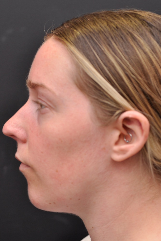 Chin Implant Before and After | Northside Plastic Surgery