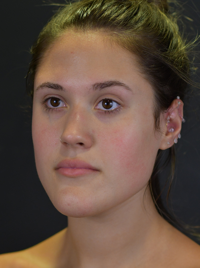 Chin Reduction Before and After | Northside Plastic Surgery
