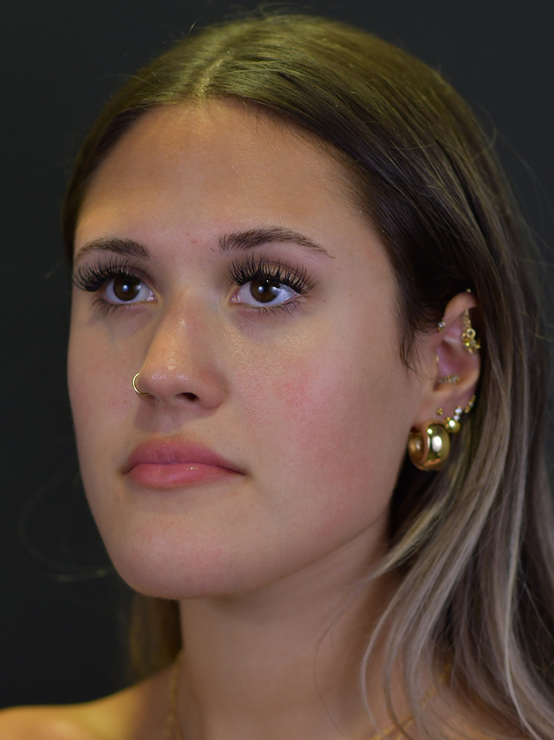 Chin Reduction Before and After | Northside Plastic Surgery