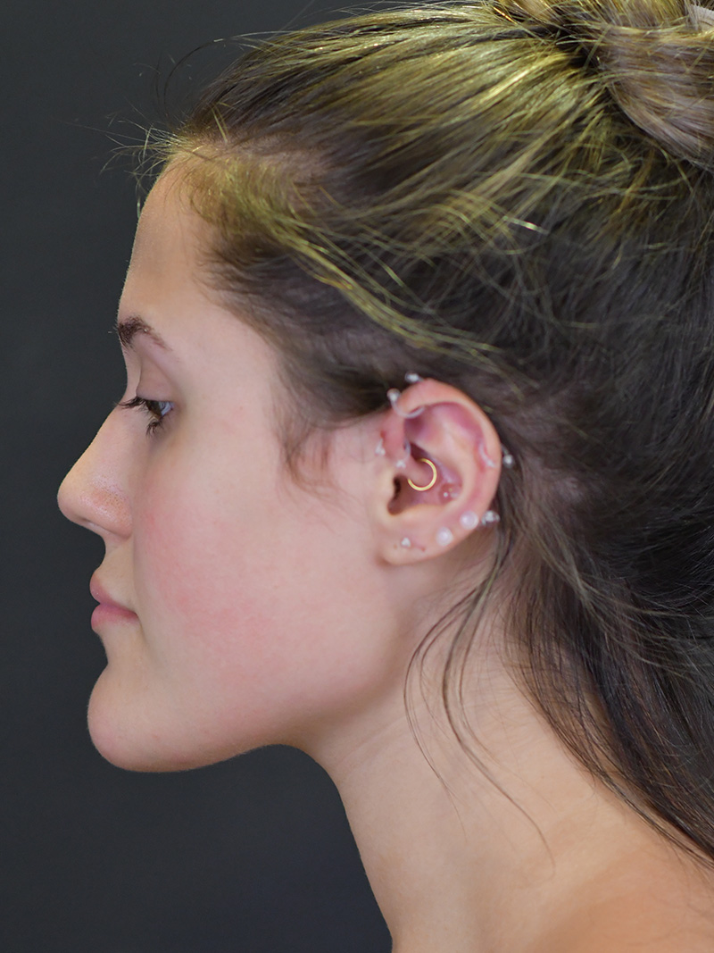 Chin Reduction Before and After | Northside Plastic Surgery