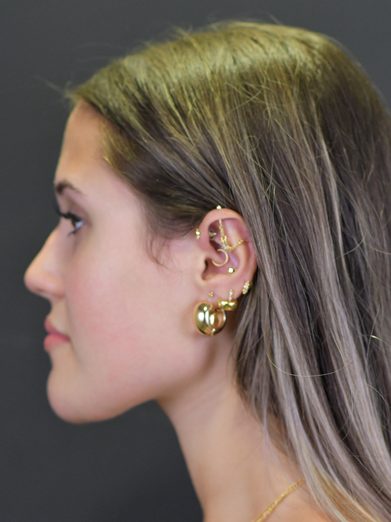 Chin Reduction Before and After | Northside Plastic Surgery